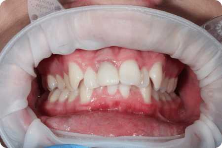 До: Лечение скученности зубных рядов и прикуса
