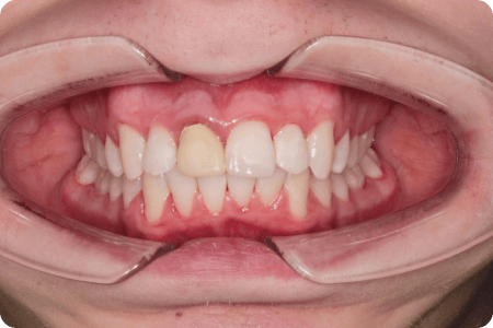 После: Лечение скученности зубных рядов и прикуса