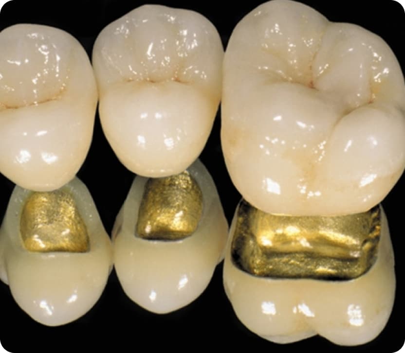 Как мы видим, вариантов применения зубной коронки чуть больше, чем может показаться на первый взгляд.