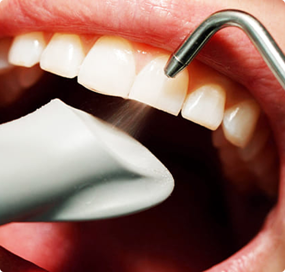 Чистка зубов Air Flow