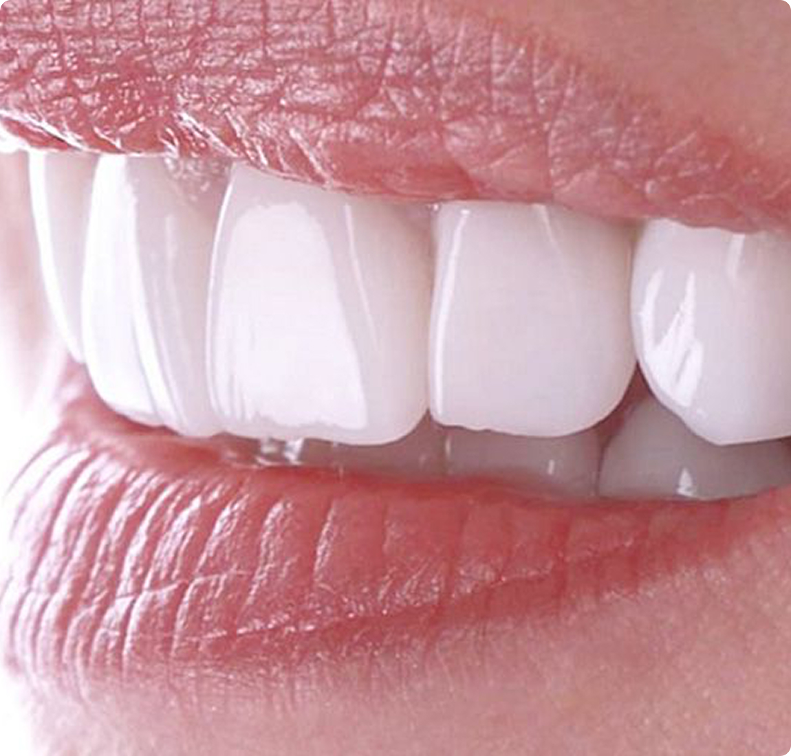 Керамические коронки (E-Max)