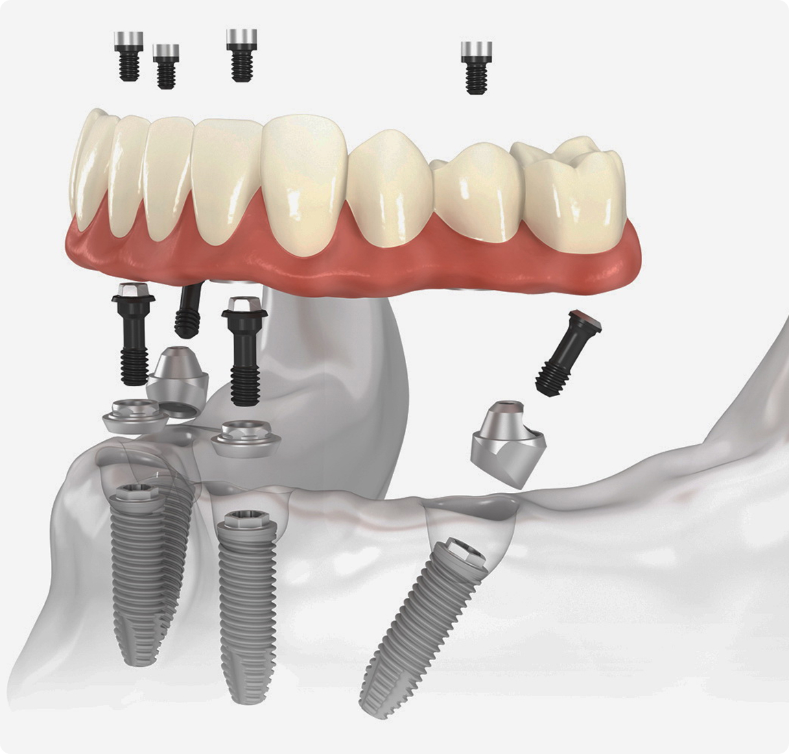 Протезирование на 4 имплантах (All-on-4)