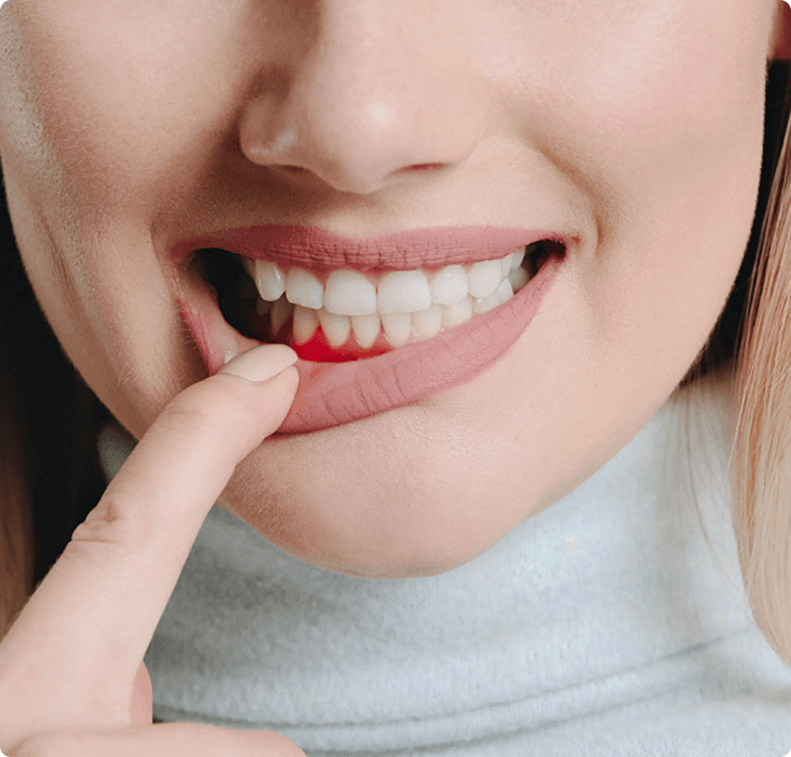 Лечение гингивита у взрослых