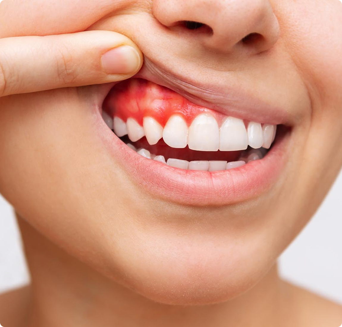 Лечение пародонтита