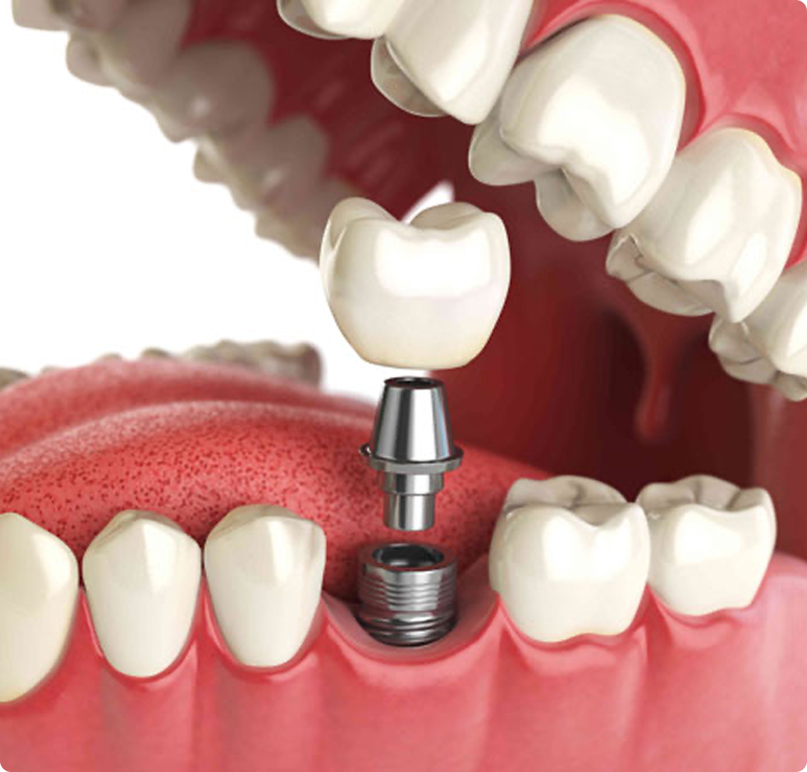 Протезирование на имплантах