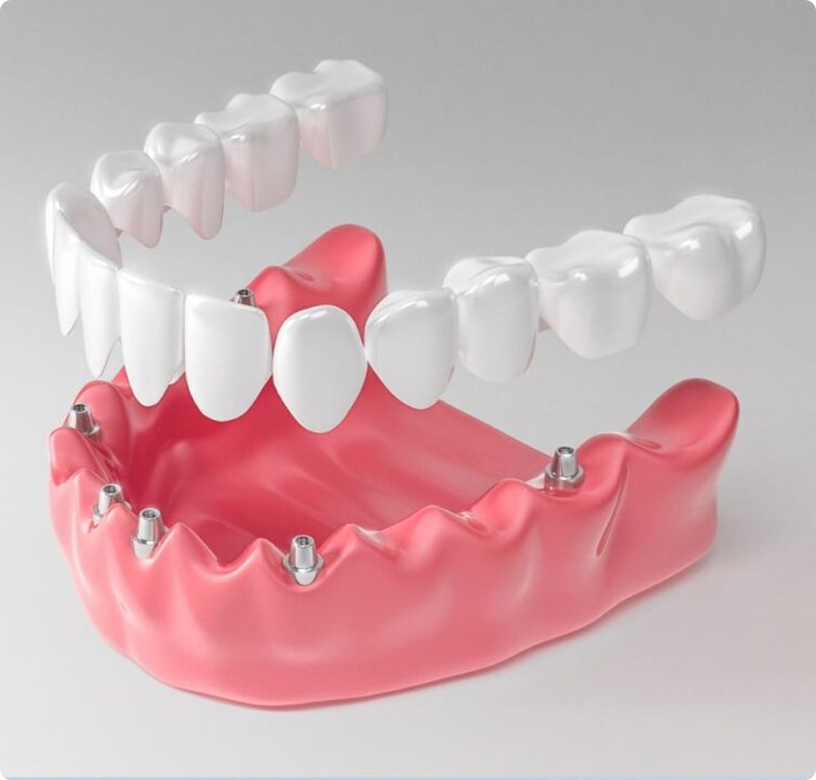 Съёмные зубные протезы